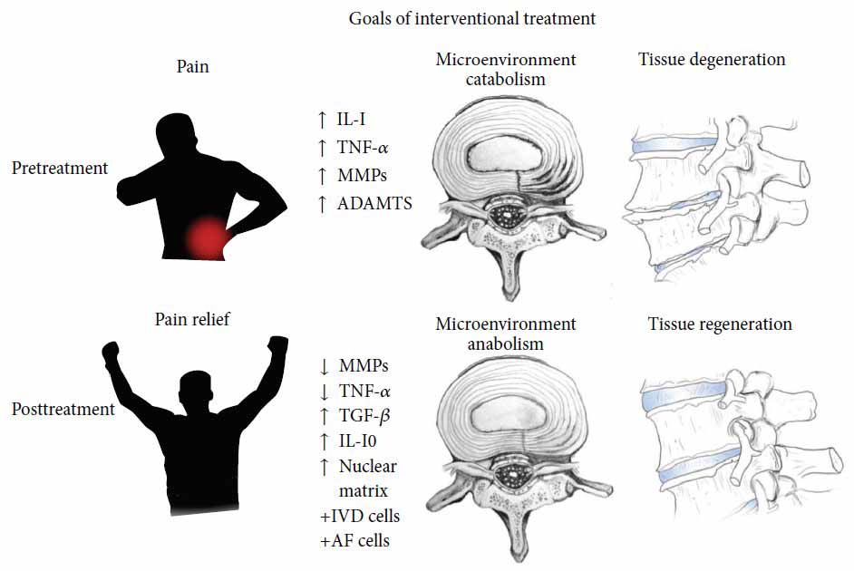 Stem Cell Treatment of Degenerated Discs and Back Pain