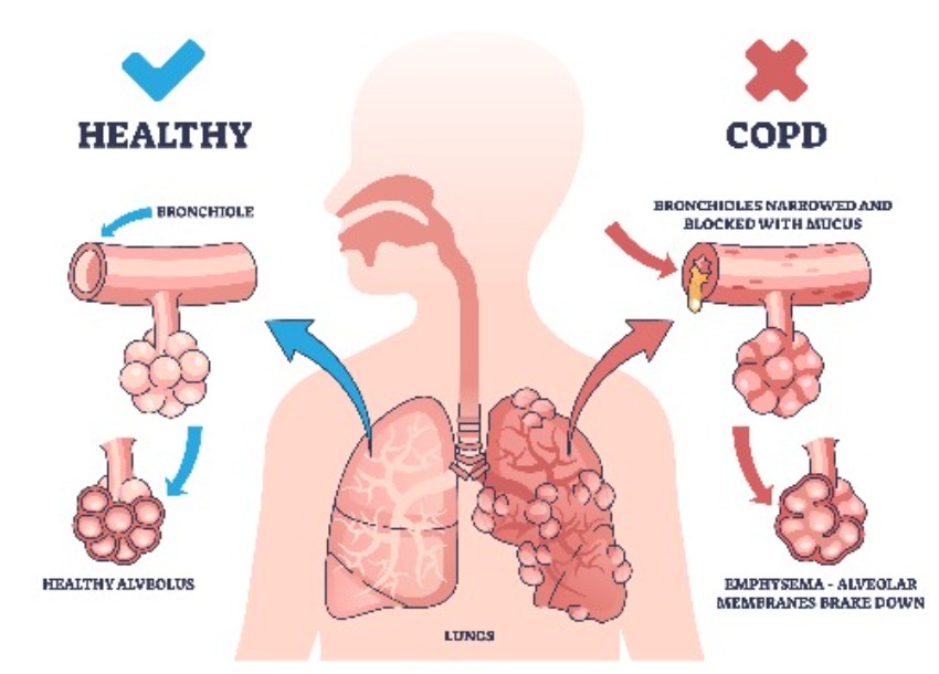 Diagram comparing Healthy Lung vs. COPD Affected Lung