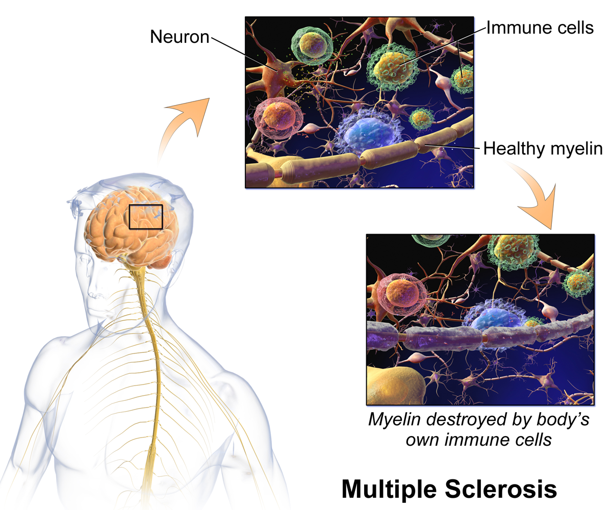 the body's own immune cells destroy myelin in Multiple Sclerosis 