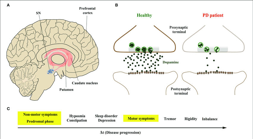 ANOVA-IRM-Germany-Parkinsons-disease-PD-dopaminergic-neurons-stem-cell-therapy ANOVA-IRM-Germany-Parkinsons-disease-PD-dopaminergic-neurons-stem-cell-therapy