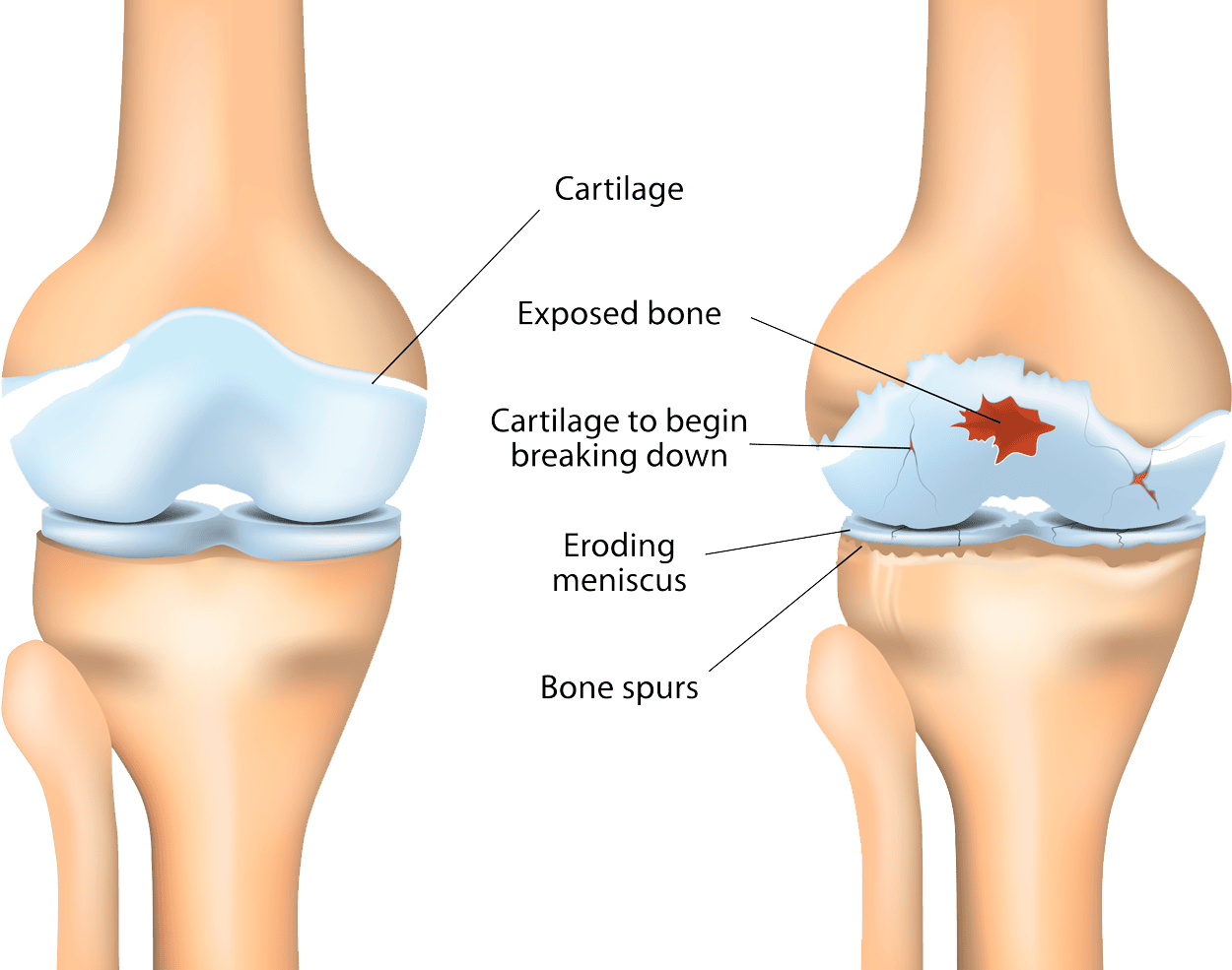Joint and cartilage degeneration in RA | ANOVA
