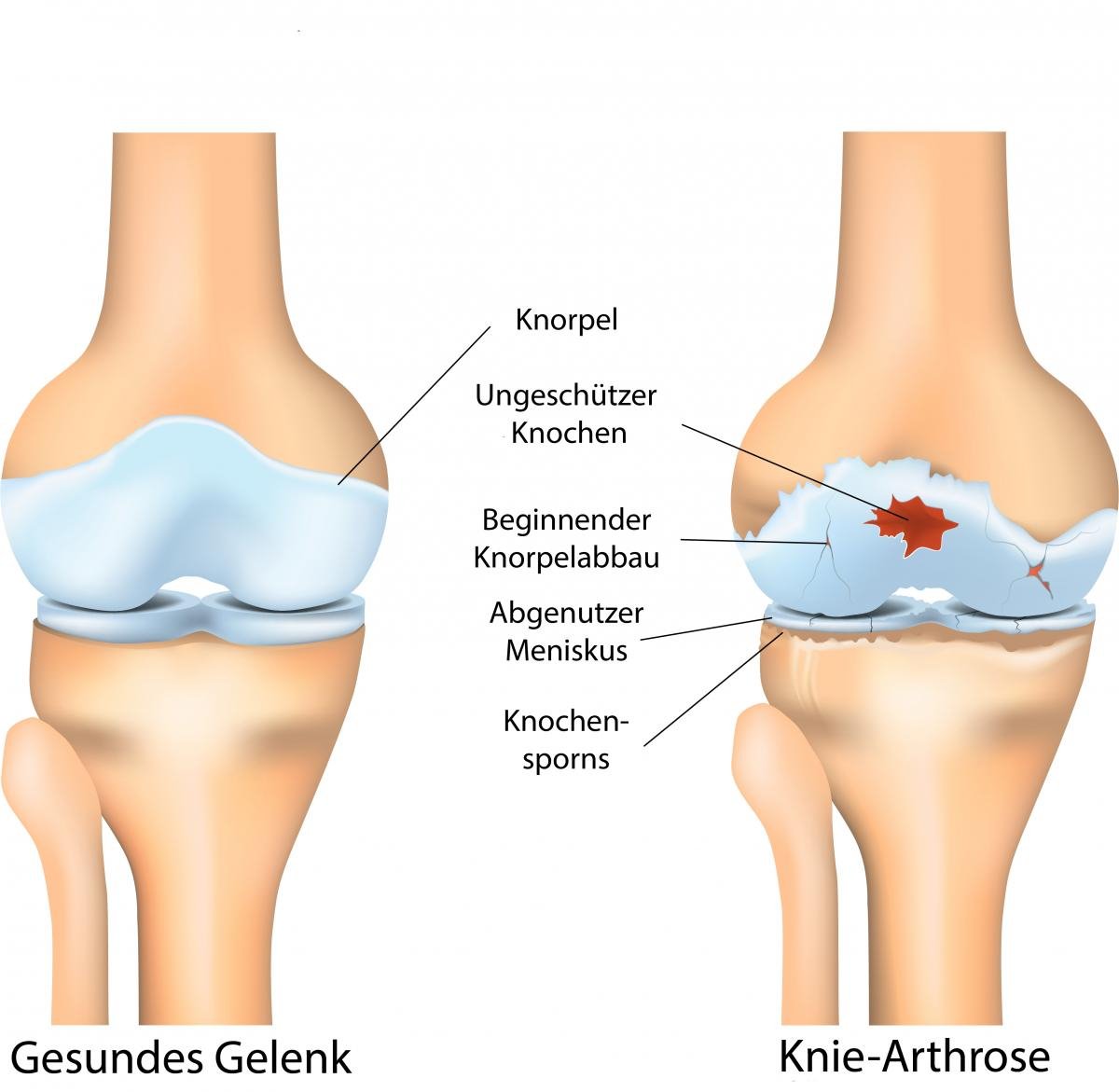 Gelenkschäden bei Arthrose und Arthritis | ANOVA​ IRM