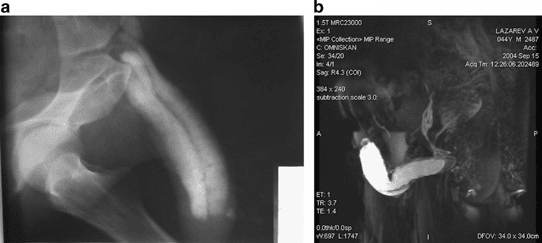 Erectile dysfunction ED diagnostics MRI Ultrasound US | Germany