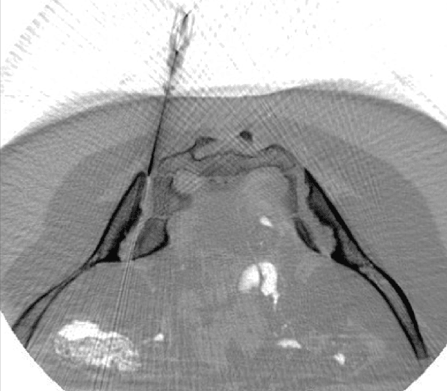 ANOVA IRM Deutschland - CT geführte Gelenkinjektion Stammzellen