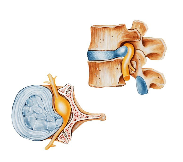 Back pain and degenerative disc disease nerve compression | ANOVA