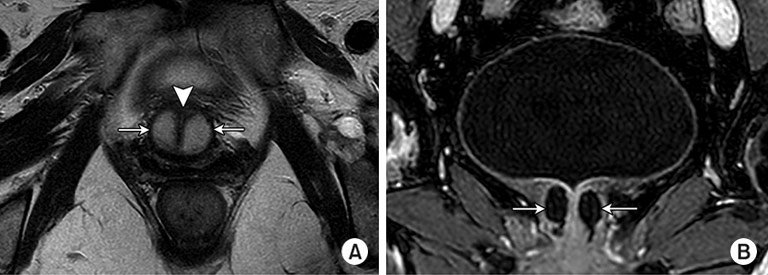 PRP-platelet-rich-plasma-therapy | Germany