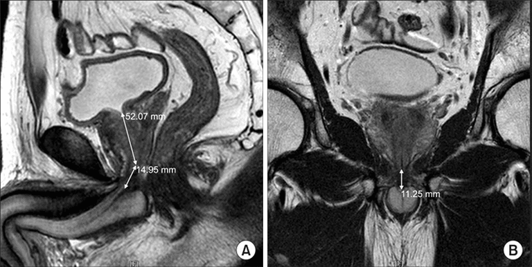 PRP-platelet-rich-plasma-therapy | Germany